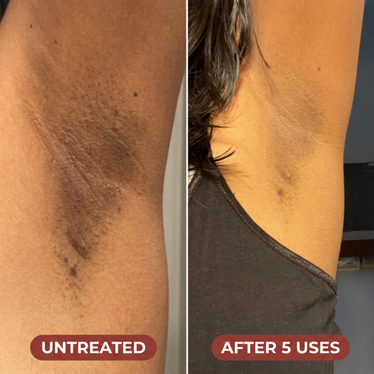 Triple Acid Keratosis Pilaris Complex