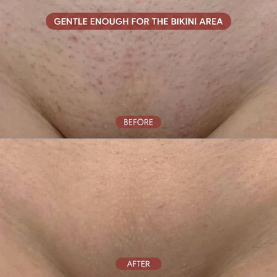 Triple Acid Keratosis Pilaris Complex