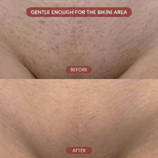 Triple Acid Keratosis Pilaris Complex