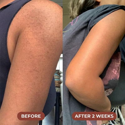 Triple Acid Keratosis Pilaris Complex